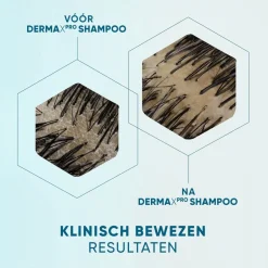 Outlet Head & Shoulders DermaXPro by Kalmeert Antiroosshampoo